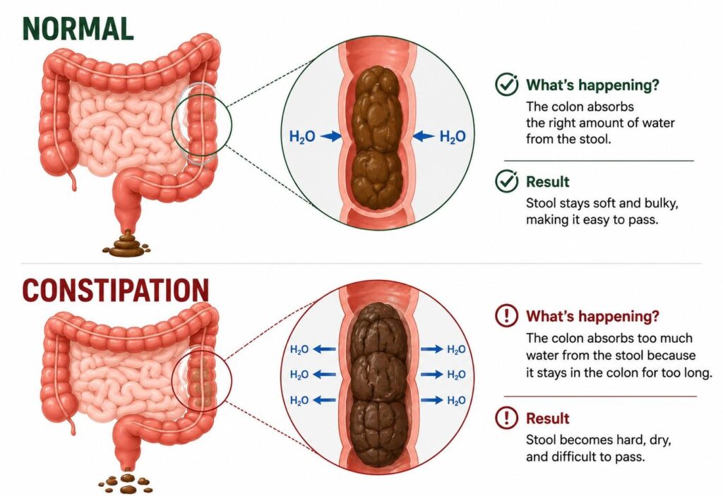 Infographic comparing normal colon water absorption with constipation, illustrating how a sluggish colon absorbs too much water, leaving stool hard and dry.